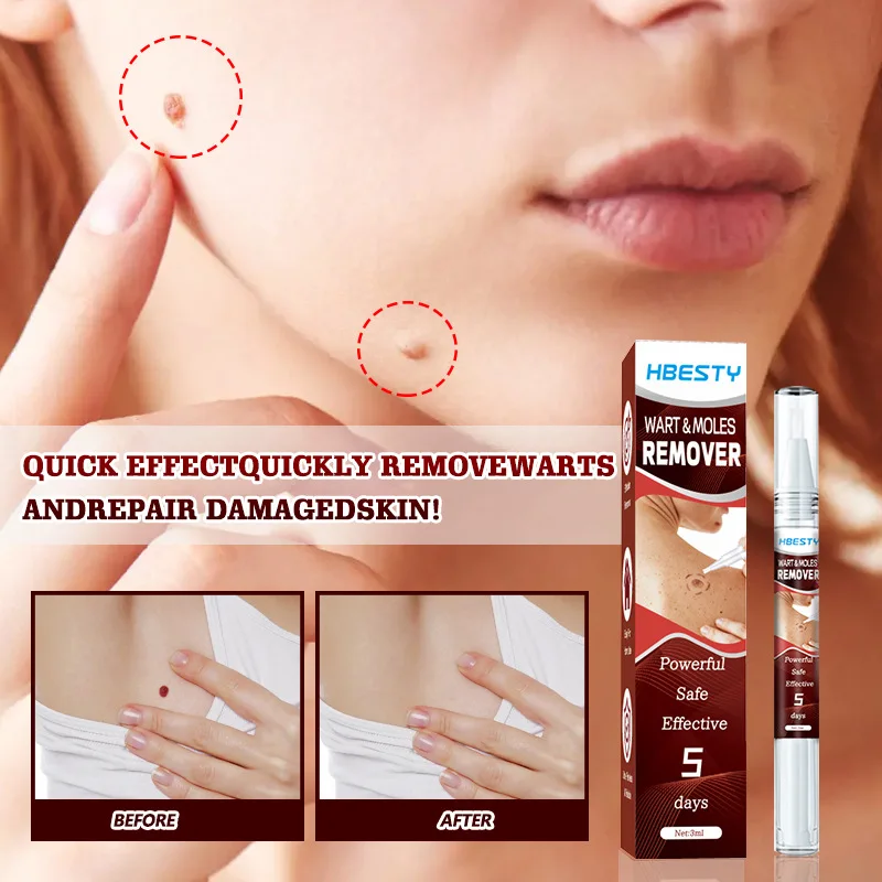 OEM Wart & Moles Cream for Improving Skin Problem