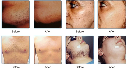 Factory price diode Laser Beauty Equipment/Portable Elight ipl+rf/IPL hair removal Sincoheren Medical Solutions 2021