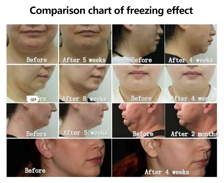 Cryolipolysis Fat Freezing + Ems Sculpting Machine 11 Fast Result Exercise Weight Loss Slimming Machine New Tech Rf Ems + Cryolipolysis Machine For Cellulite Removal Body Shape 2024