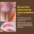 Acne Mark Private Label Hyaluronic Pimples Acne Scar Mark Skin Repair Acid Cream Scar Remover