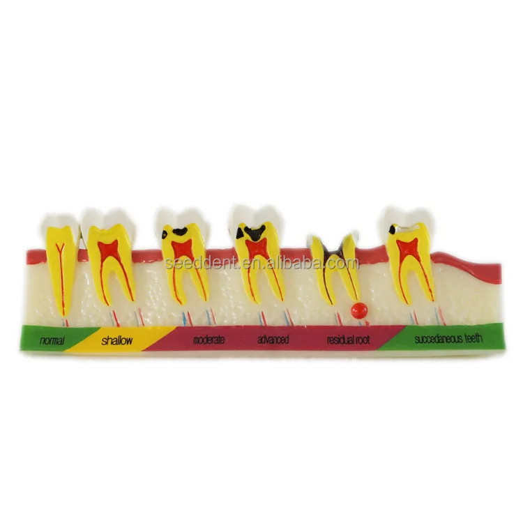 Dental Caries Developing Model Dental Medical Teeth Teaching Model