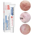 Skin Acne Cream Korea Oem Acne Melasma Removal Vitamin A Fruit Acid Skin Anti Acne Treatment Cream Gel