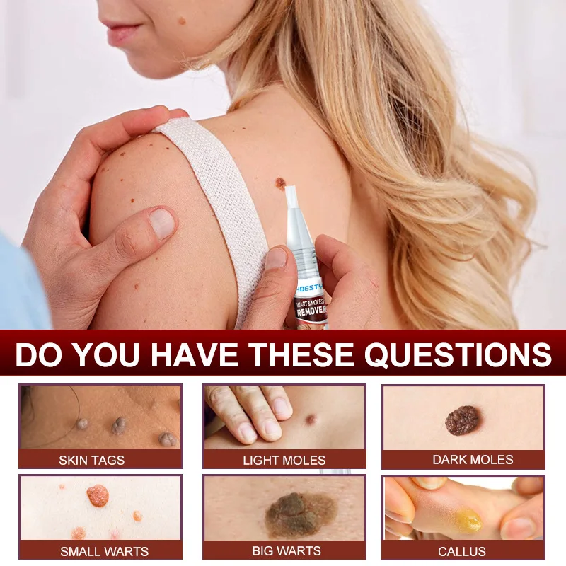 OEM Wart & Moles Cream for Improving Skin Problem
