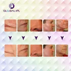 Scars Scars Fractional Laser Professional Co2 Fractional Laser 30w Remove Acne Scars