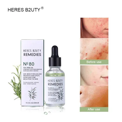 serum acne tea tree oil