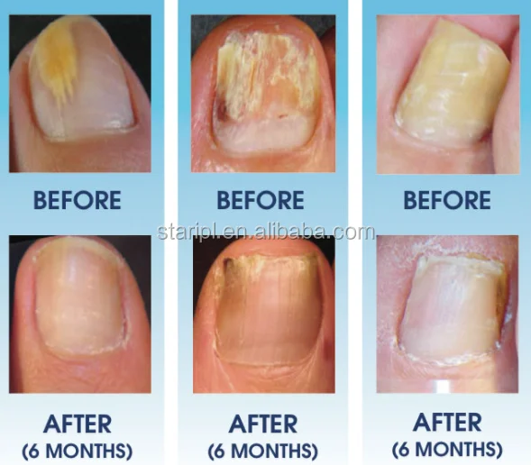 nail fungus removal (2).png