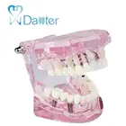 Model Schools Dental Disease Removable Demonstration Study Teaching Teeth Model For Dentists And Schools
