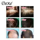 Hair Loss Shampoo Top Grade Hair Regrowth Shampoo/anti Hair Loss Shampoo/herbal Shampoo