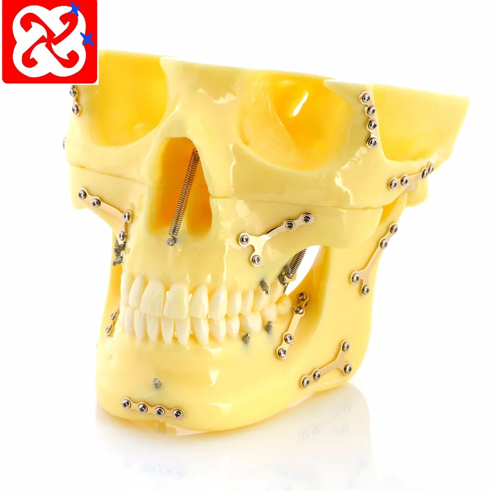 Sabit Kemik Kirigi Titanyum Plaka Ve Ortho Implant Dis Kafatasi Modeli Buy Plaka Dis Modeli Ortho Implant Kafatasi Dis Modeli Implant Ve Ortho Implant Dis Modeli Ile Sabit Kirilma Product On Alibaba Com