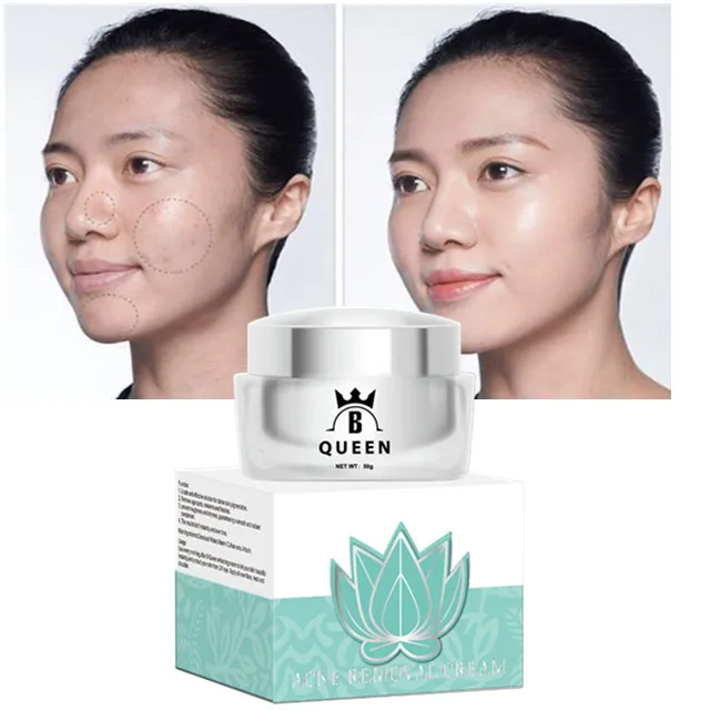 face cream for acne and dark spots