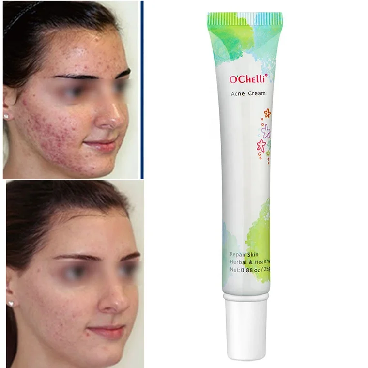 best acne cream