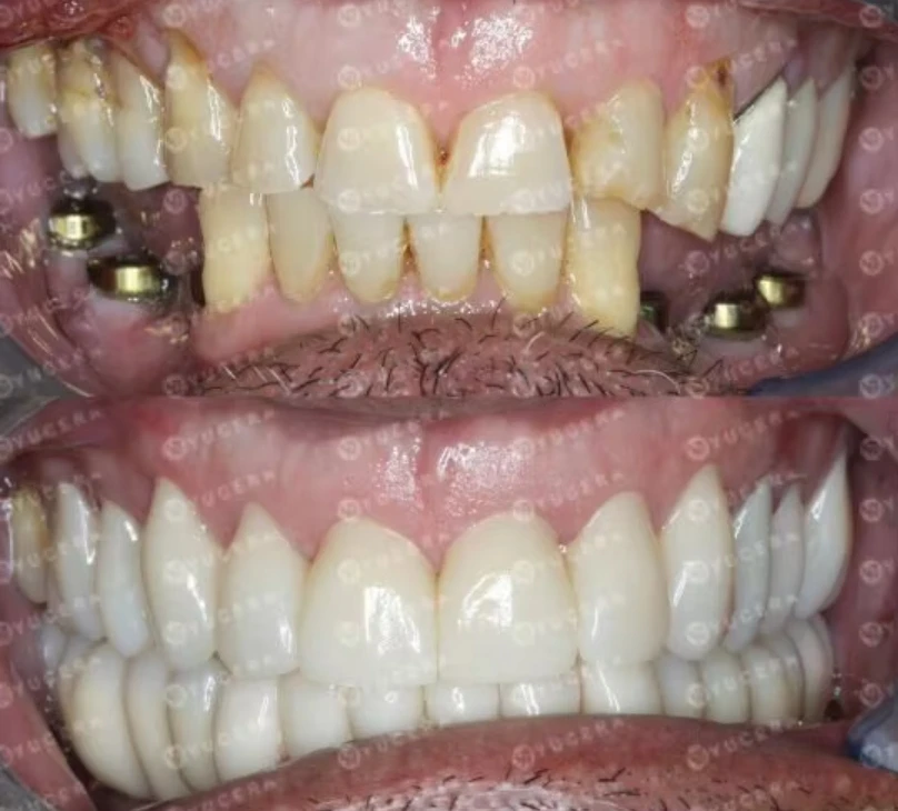 Yucera 4D PRO Multilayer Zirconia Block Factory Direct Sale Dental Consumables CAD/CAM Multilayer Zirconia Disc for Full Arch