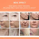 Frequency 2mhz RF Radio Frequency Lifting Machine Wrinkle Removal Face Lifting Skin Tightening