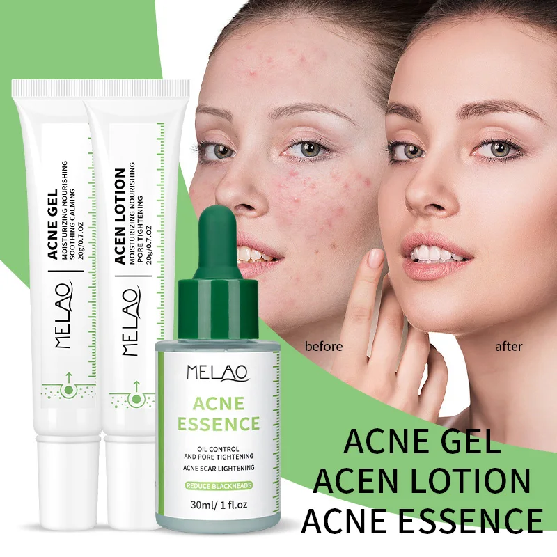 Salicylic Acid Pore Shrink Essence Oil Control Acne Repair Face Moisturizing For Blackheads Acne With Active Ingredients