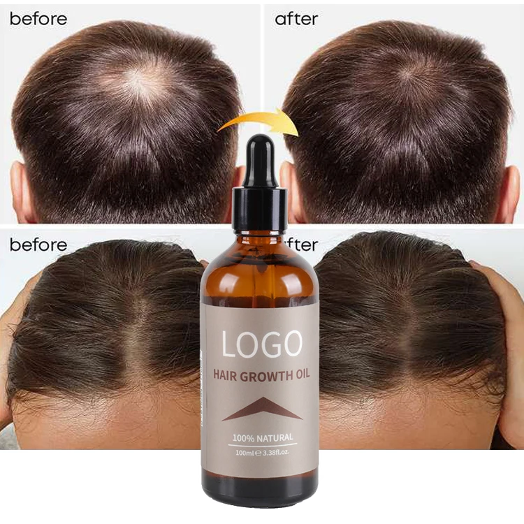 Anti Hair Loss Treatment Organic Ginger Hair Growth Oil Serum Natural  Private Label Herbal Grow Hair Regrowth Oil - Buy Hair Growth Cream,Biotin  Shampoo And Conditioner For Hair Growth,Hair Growth Set Product