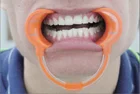 Retractors Retractor Disposable Cheek Retractors Dental Medical Dental Cheek Retractor Soft Dental Retractor