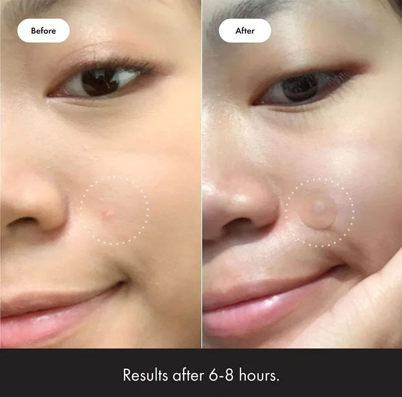 Oem Patch Original Hydrocolloid Acne Pimple Patches 36 Private Label Patch Original From Hero