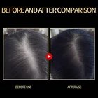 Hair Growth Medical Herbal Extract Formula Anti-hair Loss Oil Alopecia Hair Thickening Hair Growth Serum