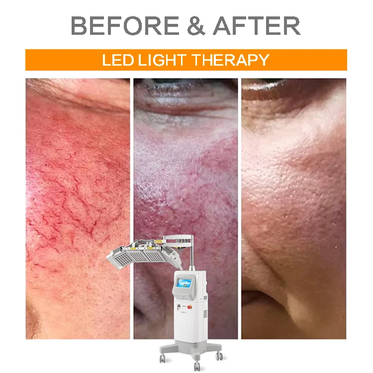 Apolomed pdt led light therapy machine machine manufacture