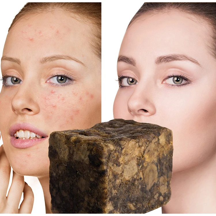 Acne Black Soap ubicaciondepersonas.cdmx.gob.mx