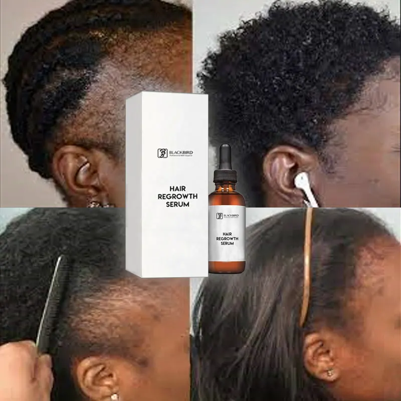 Odm Original Oil Bald Head Hair Growth Serum Treatment Bald Hair Cream  Growth Oil Baldness Scalp Hair Growth Serum - Buy Hair Growth Serum,Hair  Growth Oil,Bald Hair Cream Especially For African Hair