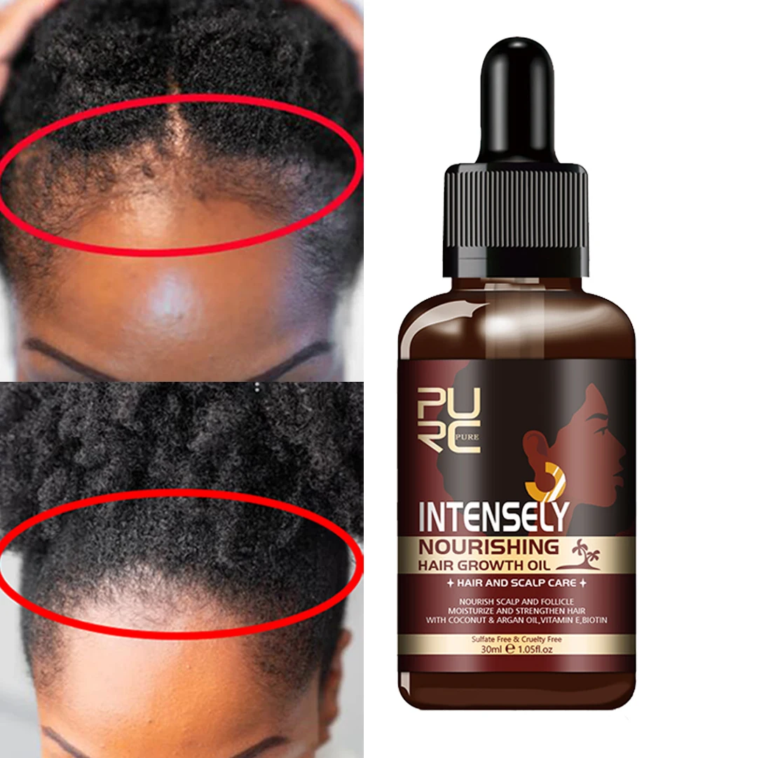 Hair And Scalp Treatment Oil Afro 4c Black Women Natural Hair Growth Oil  Organic Nourish Scalp Strengthen Hair Oil Care Serum - Buy Hair Grwoth Oil,Hair  Oil,Hair Growth Serum Product on Alibaba.com