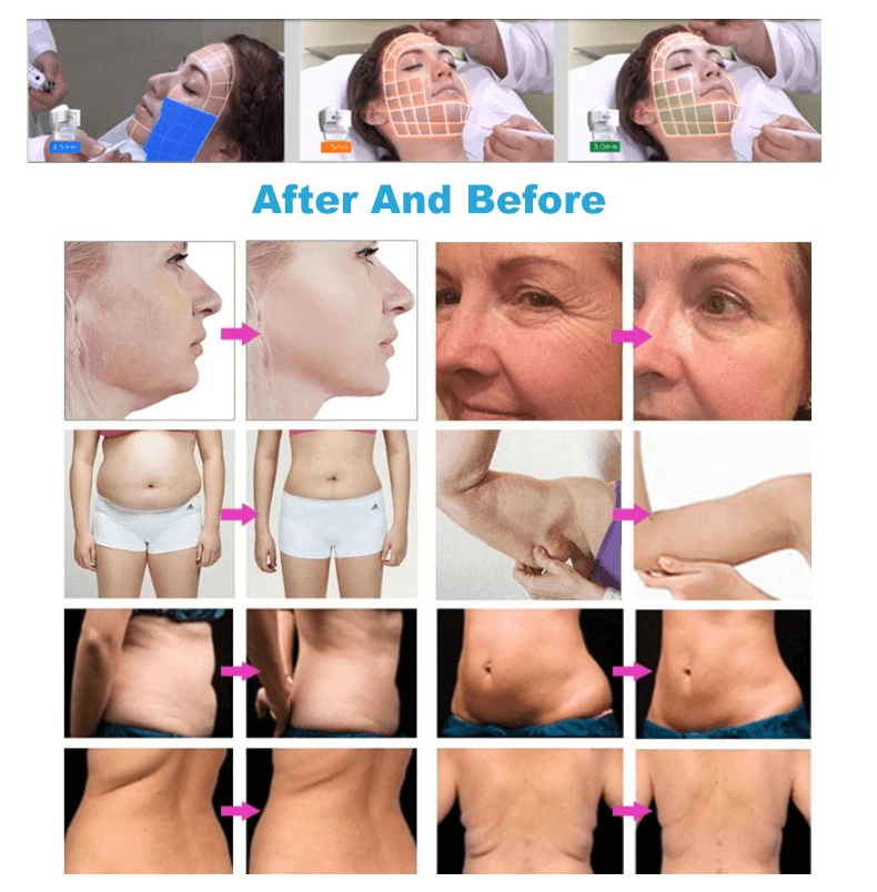7D HIFU Machine – Face Lifting & Body Slimming Device for Salons 12 High Intensity 7d Slimming Machine Wrinkle Removal Anti-aging 7 Cartridge 30000 Shots for Face Body Neck Eye Lifting Machine