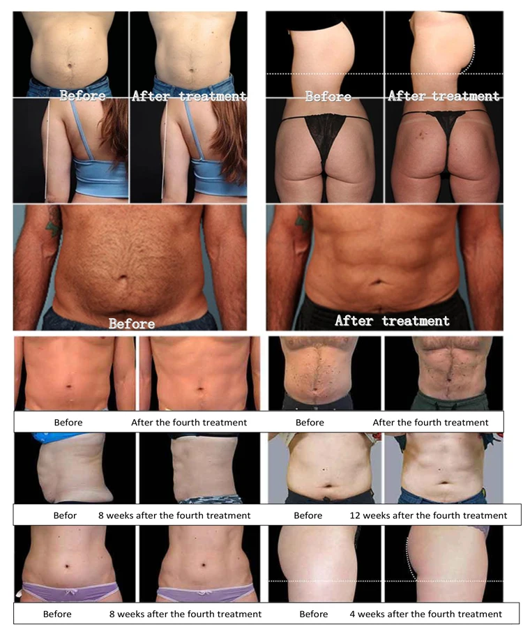 Cryolipolysis Fat Freezing + Ems Sculpting Machine 13 Fast Result Exercise Weight Loss Slimming Machine New Tech Rf Ems + Cryolipolysis Machine For Cellulite Removal Body Shape 2024