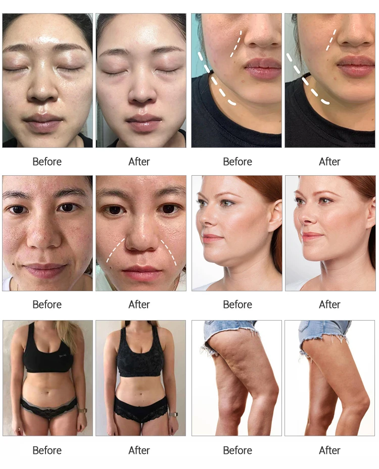 Professional 80K Cavitation Liposuction Machine 10-in-1 8 Discover the professional 10-in-1 80K cavitation liposuction machine with vacuum RF, lipolaser, BIO microcurrent, and multipolar RF technology for non-invasive body contouring and skin tightening treatments. Professional 80K Cavitation Liposuction Machine 10-in-1