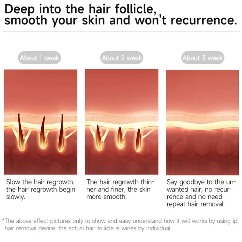 MLAY New Arrival Portable Permanent Skin Rejuvenation Ipl Laser Rapid Lighting Hair Removal IPL Home
