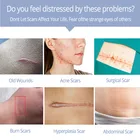 Gel Face Wholesale Private Label Skin Treatment Scar Removal Cream Anti Scar Repair Gel Acne Face Care