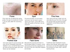 Laser Laser Newest Picosecond Laser Tattoo Removal Machine For Skin Whitening