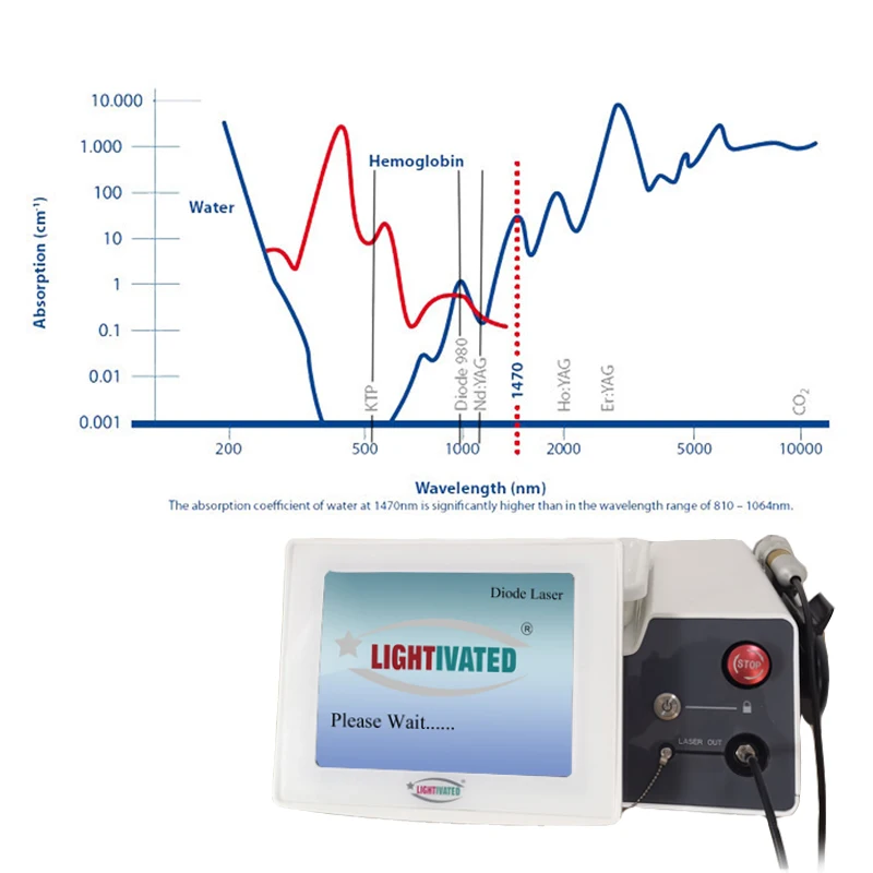 1470 hemorrhoid laser