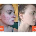 Acne Facial Serum Acne Queenbe Private Label Acne Facial Treatment Acne Skincare Pimple Removing Product Acne Serum