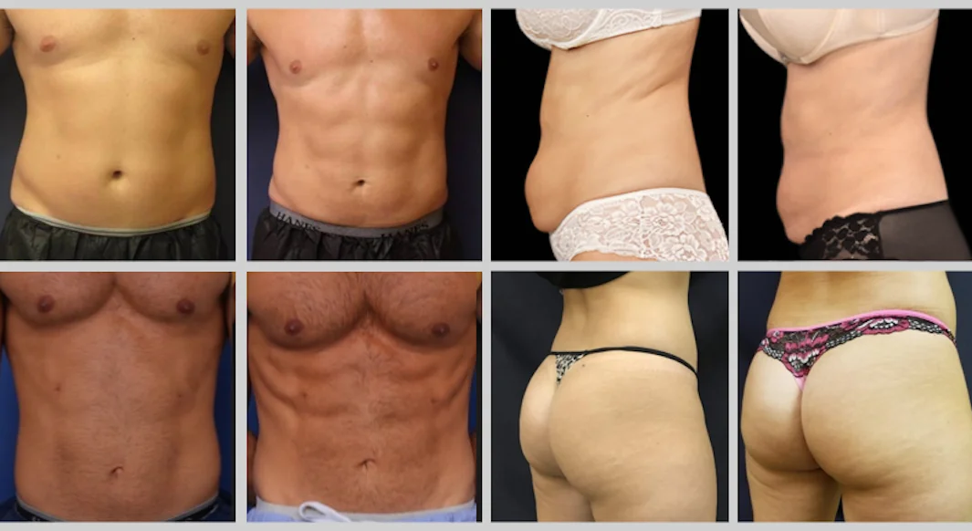 360 Cryolipolysis Fat Freezing EMS HIEMT Sculpting Machine 16 Get rid of stubborn fat without surgery- Professional Stomach Belly fat removal massage machine cool cryo sculpt 360 EMS emslim