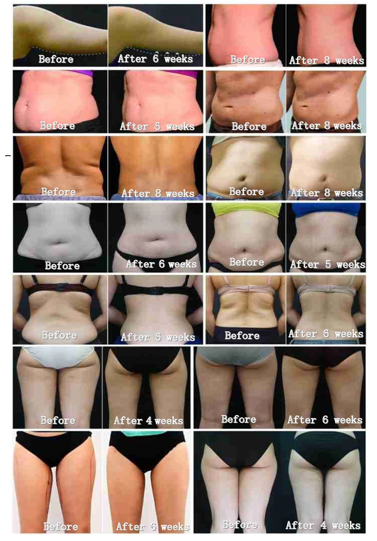 Cryolipolysis Fat Freezing + Ems Sculpting Machine 12 Fast Result Exercise Weight Loss Slimming Machine New Tech Rf Ems + Cryolipolysis Machine For Cellulite Removal Body Shape 2024