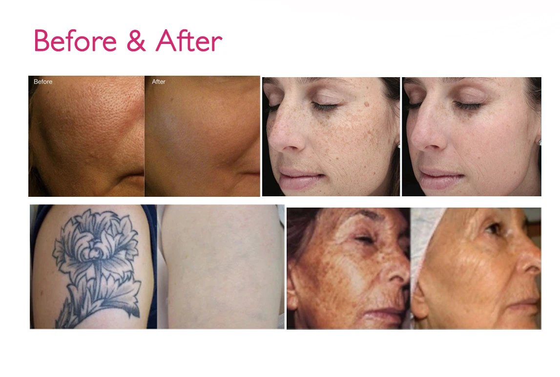 Best price professional q switch laser tattoo eyebrow tattoo removal carbon peeling birth mark removal