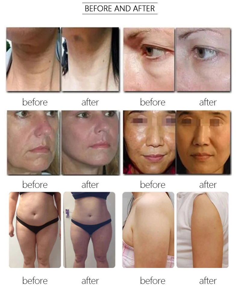 Best 7D HIFU Machine Professional MMFU For Sale 5 TECHNICAL SPECIFICATIONS <ul> <li>Power: 300W</li> <li>Voltage: 100V/110V/220V</li> <li>Energy output: 0.1J-2.0J</li> <li>Screen Size: 10.4 inches touch screen</li> <li>HIfu Cartridges: 1.5/2.0/3.0/4.5/6.0/8.0/10.0/13.0mm</li> <li>Cartridge Shots: 10,000 shots</li> <li>Dot distance: 1-2mm(Set unit 0.1mm)</li> <li>Frequency: 2MHz / 4MHz / 5.5MHz / 7MHz</li> <li><span class="attr-name J-attr-name" title="HIFU Length" data-spm-anchor-id="a2700.wholesale.0.i34.67a066f4kJ6h3j">HIFU Length: </span>5-25mm Adjustable</li> <li>Package Size: 55*54*37CM</li> <li>Package Weight: 17 kg</li> <li>ReturnPolicy: <b class="magic-5"><span style="color: #2196ed;">30 Days Money back guarantee</span></b> <a href="http://tattoosemi.com/refund_returns" data-sm="true">Return Policy</a></li> <li>ShippingDetails: <b class="magic-5"><span style="color: #2196ed;">FREE SHIPPING fast delivery</span></b> <a href="https://tattoosemi.com/shipping-policy" data-sm="true">Shipping policy</a></li> </ul> Best 7D HIFU Machine Professional MMFU For Sale