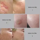 Laser Acne Laser Co2 Fractional Laser Co2 Co2 Fractional Laser Acne Scar Removal Equipment