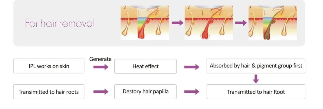 Best permanent laser hair removal machine portable Hair removal machine