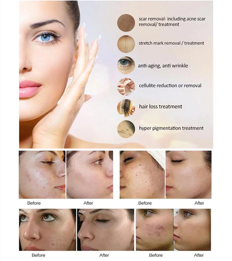 2024z Professional Dr Pen A6 Microneedling Pen Mts Beauty Device for Skin Rejuvenation Acne Scar Anti Wrinkles