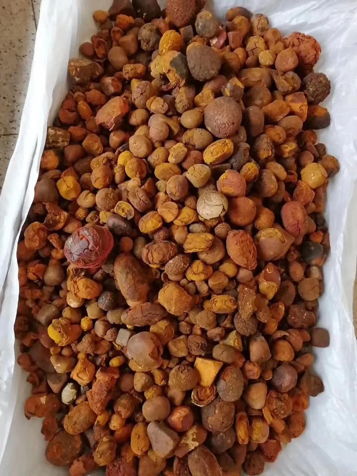 gallstones 7.jpg