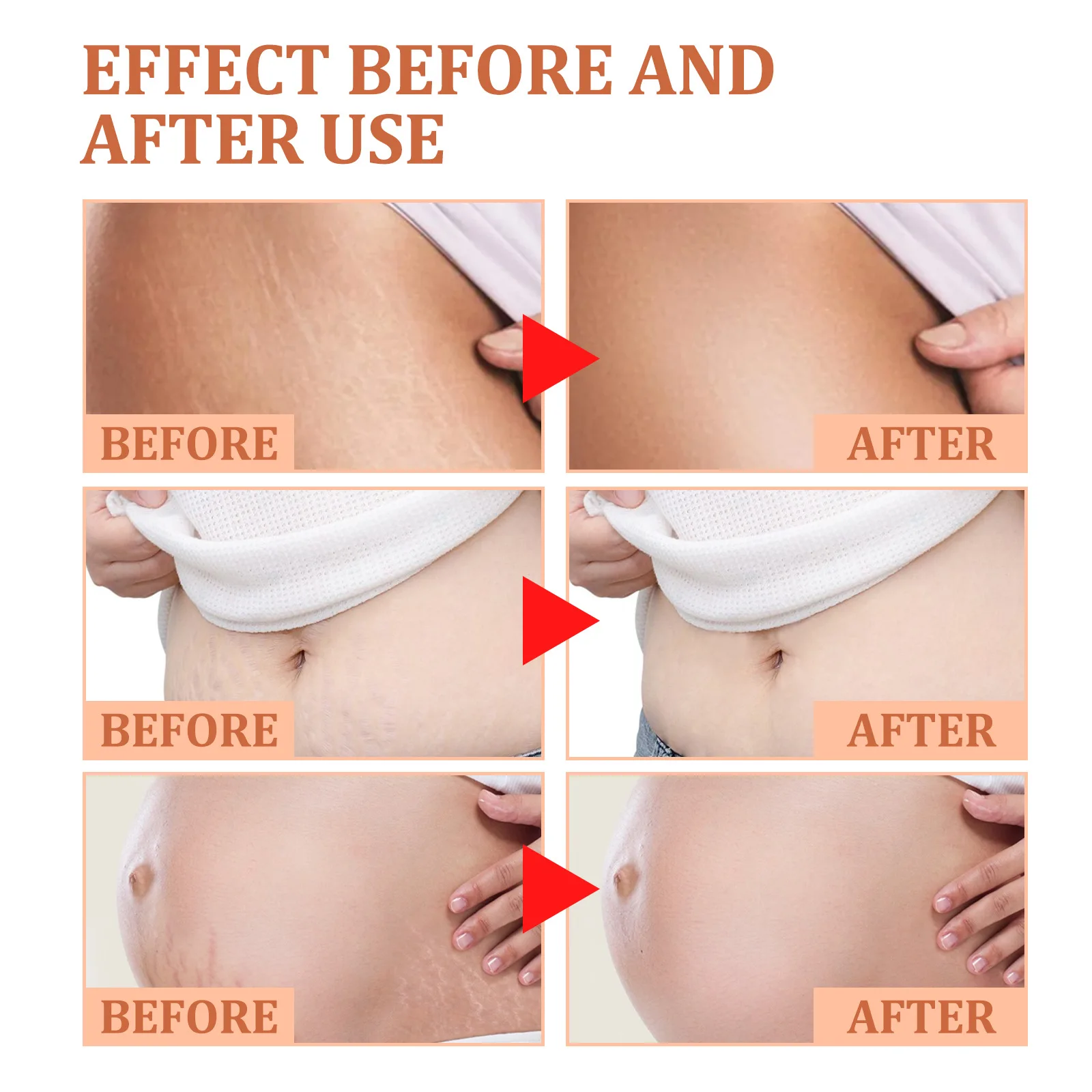 Best Selling Vegan Frmula Mild and Non-Irritating Fast Acting Smooth Skin Stretch Mark Repair Cream