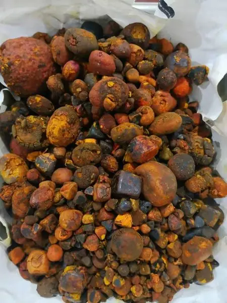 gallstones 1.jpg