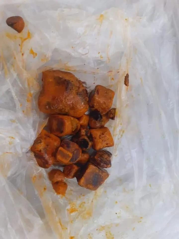 gallstones 8.jpg
