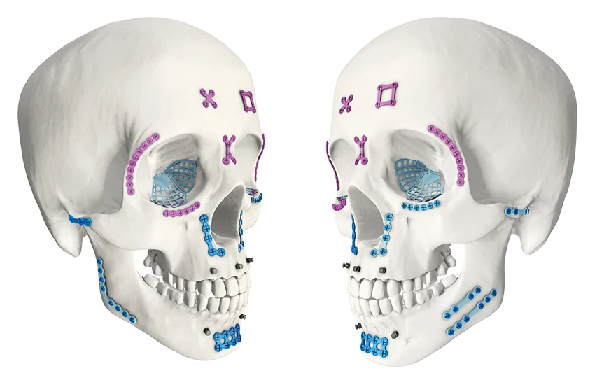 Titanium Angle Reconstruction Mandibular Fixation Bone Plates Left