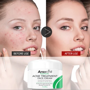 private label custom natural organic tea tree blackhead & pimples remover anti acne scar removal treatment face cream for acne