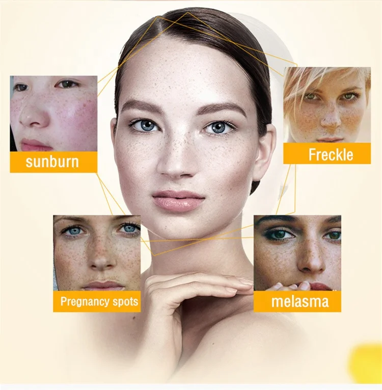 SNMLPM 30g Freckle Cream Deep Moisturizing Melanin Freckle Cream Dark Spots Acne Scar Face Whitening Cream