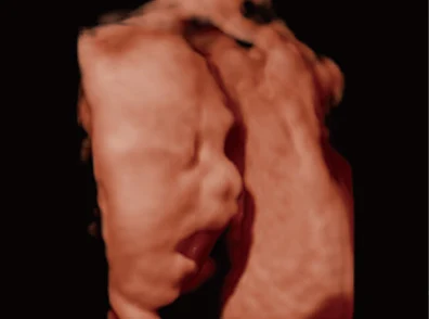 Sonoscape P20 Mobile 3D/4D Real-time Color Panoramic Doppler Trolley Ultrasound Machine details