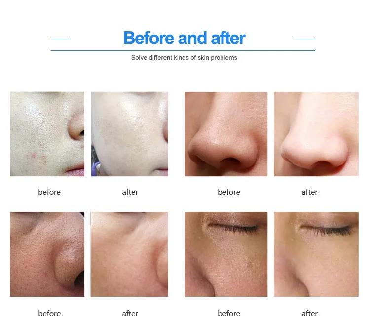 Beauty salon use hydro dermabrasion 4 bottle water oxygen  facial skin tightening facial cleaning beauty device